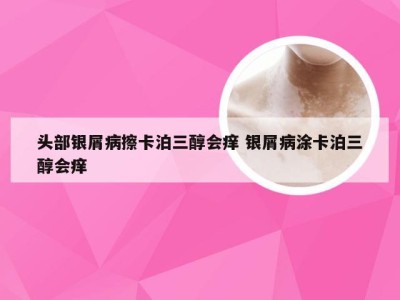 头部银屑病擦卡泊三醇会痒 银屑病涂卡泊三醇会痒