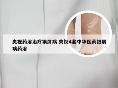央视药浴治疗银屑病 央视4套中华医药银屑病药浴