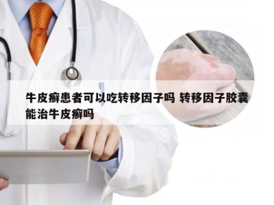 牛皮癣患者可以吃转移因子吗 转移因子胶囊能治牛皮癣吗