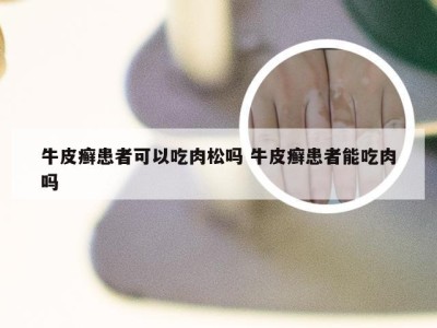 牛皮癣患者可以吃肉松吗 牛皮癣患者能吃肉吗
