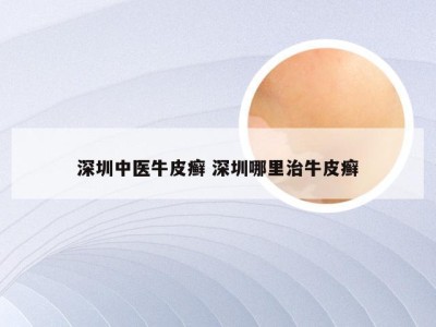 深圳中医牛皮癣 深圳哪里治牛皮癣