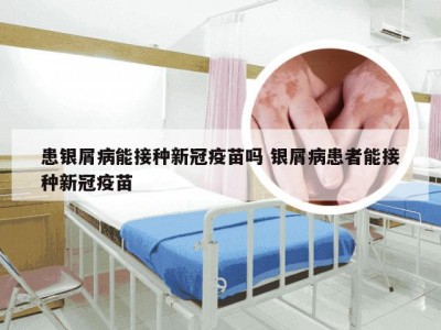 患银屑病能接种新冠疫苗吗 银屑病患者能接种新冠疫苗