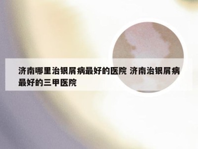 济南哪里治银屑病最好的医院 济南治银屑病最好的三甲医院