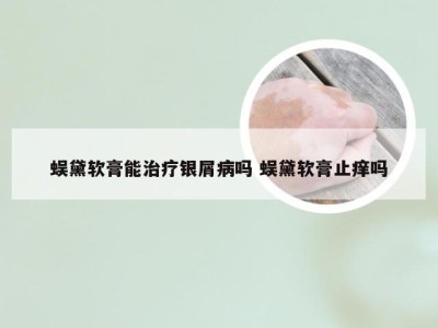 蜈黛软膏能治疗银屑病吗 蜈黛软膏止痒吗