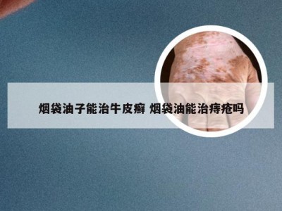 烟袋油子能治牛皮癣 烟袋油能治痔疮吗