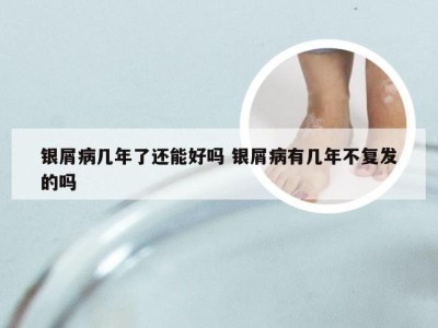 银屑病几年了还能好吗 银屑病有几年不复发的吗