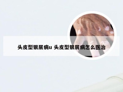 头皮型银屑病u 头皮型银屑病怎么医治