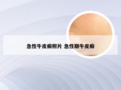 急性牛皮癣照片 急性期牛皮癣