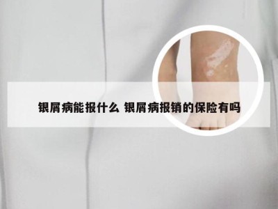银屑病能报什么 银屑病报销的保险有吗