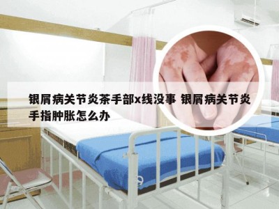 银屑病关节炎茶手部x线没事 银屑病关节炎手指肿胀怎么办