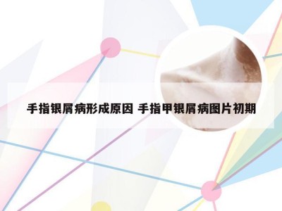 手指银屑病形成原因 手指甲银屑病图片初期