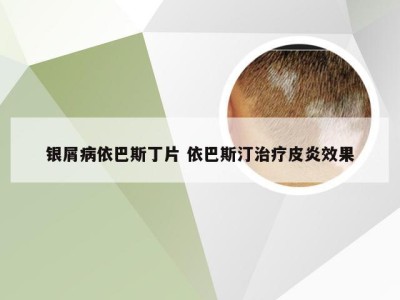 银屑病依巴斯丁片 依巴斯汀治疗皮炎效果