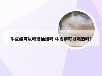 牛皮癣可以喝酒抽烟吗 牛皮癣可以喝酒吗?