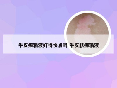 牛皮癣输液好得快点吗 牛皮肤癣输液