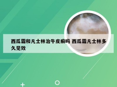 西瓜霜和凡士林治牛皮癣吗 西瓜霜凡士林多久见效