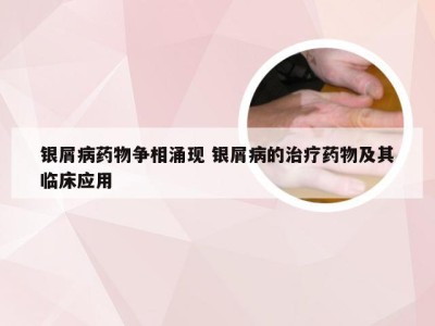银屑病药物争相涌现 银屑病的治疗药物及其临床应用