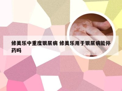 修美乐中重度银屑病 修美乐用于银屑病能停药吗