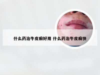 什么药治牛皮癣好用 什么药治牛皮癣快
