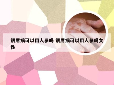 银屑病可以用人参吗 银屑病可以用人参吗女性