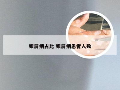 银屑病占比 银屑病患者人数