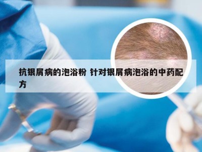 抗银屑病的泡浴粉 针对银屑病泡浴的中药配方