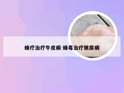 蜂疗治疗牛皮癣 蜂毒治疗银屑病
