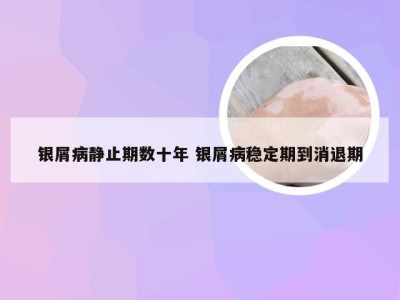 银屑病静止期数十年 银屑病稳定期到消退期