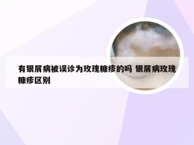 有银屑病被误诊为玫瑰糠疹的吗 银屑病玫瑰糠疹区别