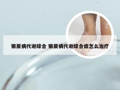 银屑病代谢综合 银屑病代谢综合症怎么治疗