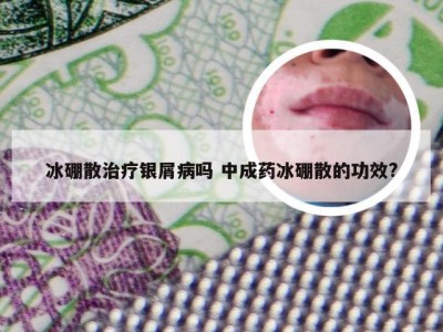 冰硼散治疗银屑病吗 中成药冰硼散的功效?