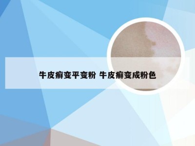 牛皮癣变平变粉 牛皮癣变成粉色