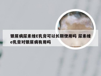 银屑病尿素维E乳膏可以长期使用吗 尿素维e乳膏对银屑病有用吗
