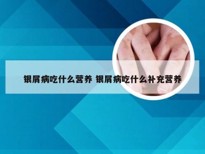 银屑病吃什么营养 银屑病吃什么补充营养