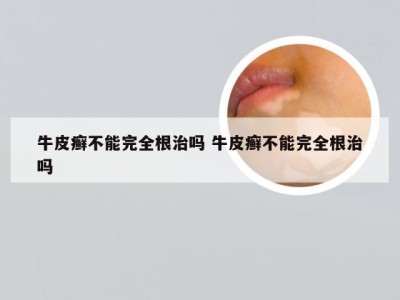 牛皮癣不能完全根治吗 牛皮癣不能完全根治吗