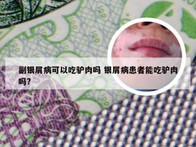 副银屑病可以吃驴肉吗 银屑病患者能吃驴肉吗?