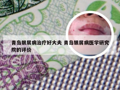 青岛银屑病治疗好大夫 青岛银屑病医学研究院的评价