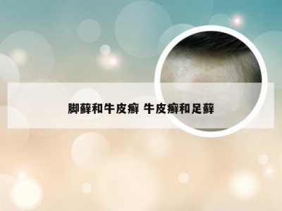 脚藓和牛皮癣 牛皮癣和足藓