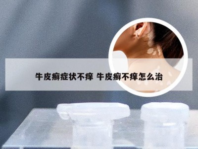 牛皮癣症状不痒 牛皮癣不痒怎么治
