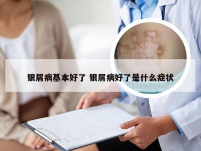 银屑病基本好了 银屑病好了是什么症状