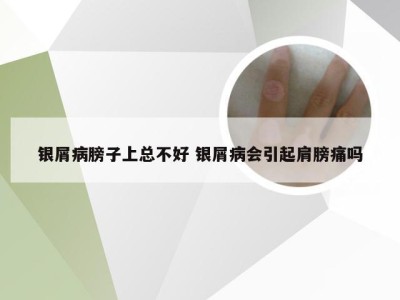 银屑病膀子上总不好 银屑病会引起肩膀痛吗