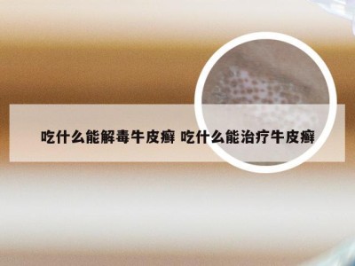 吃什么能解毒牛皮癣 吃什么能治疗牛皮癣