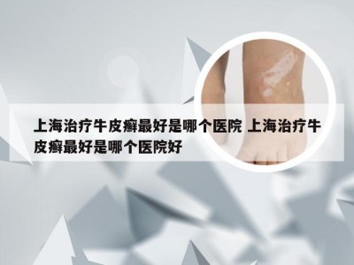 上海治疗牛皮癣最好是哪个医院 上海治疗牛皮癣最好是哪个医院好