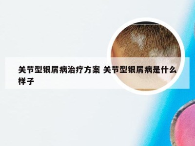 关节型银屑病治疗方案 关节型银屑病是什么样子