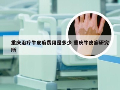 重庆治疗牛皮癣费用是多少 重庆牛皮癣研究所