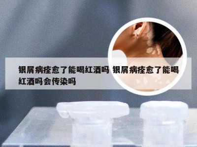 银屑病痊愈了能喝红酒吗 银屑病痊愈了能喝红酒吗会传染吗