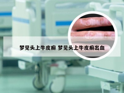梦见头上牛皮癣 梦见头上牛皮癣出血