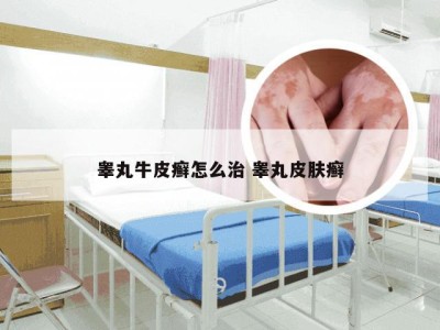 睾丸牛皮癣怎么治 睾丸皮肤癣