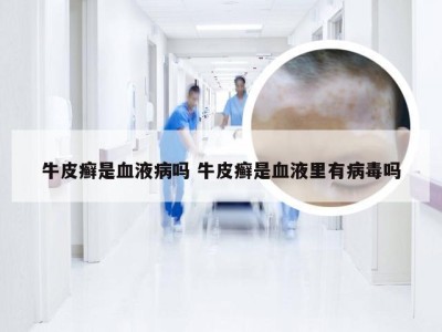牛皮癣是血液病吗 牛皮癣是血液里有病毒吗
