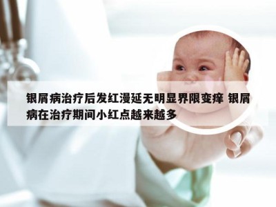 银屑病治疗后发红漫延无明显界限变痒 银屑病在治疗期间小红点越来越多