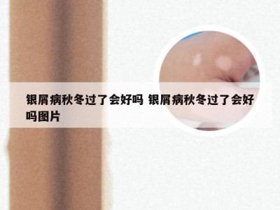 银屑病秋冬过了会好吗 银屑病秋冬过了会好吗图片